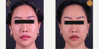 25-34 year old woman treated with FaceTite - FaceTite with facial and submental liposuction with a focus on tightening the submental neck or double chin. Results shown 5 months post-procedure.