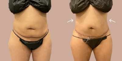 35-44 year old woman treated with AirSculpt - Patient received Stomach AirSculpt along with Tiny Tuck which is a smaller skin removal procedure compared to a traditional tummy tuck.