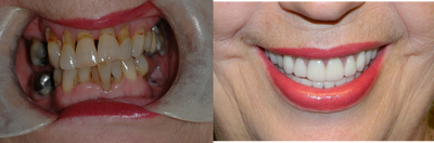 65-74 year old woman treated for ClearChoice Dental Implants - Upper and lower hybrid denture