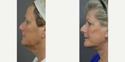 Woman treated with ActiveFX - DEEP PLANE FACE & NECK LIFT with ACTIVE FX LASER RESURFACING. Dr. James Marotta see this patient back in office for her 6 month + post op visit. Check out that neck line and glowing skin! Beautiful, natural results worth sharing.