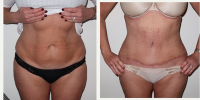 45-54 year old woman treated with Drainless Tummy Tuck - Drainless Lipo-Abdominoplasty, follow up at 2 months.Here this patient had rectus divarication and central abdominal fullness with moderate skin excess.A full lipo-abdominoplasty was performed with low scar placement. Progressive tension closure technique without drains was used to keep the scar low and improve waist definition.There was also present a sizable umbilical hernia which was repaired directly at the same time without the need for synthetic mesh.