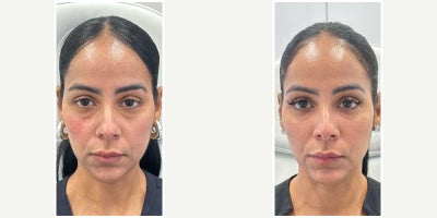 35-44 year old woman treated with Dermal Fillers, Botox, Nonsurgical Neck Lift - Mid Face and Under eye filler and botox to the lower face to lift the neck and lower face by Nurse Cindy.