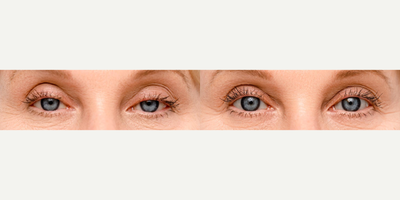 Woman treated with Upneeq - Woman treated with Upneeq