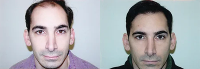 Hair Transplant  - 	Male pattern baldness (Alopecia) corrected/treated using the most advanced surgical hair restoration techniques