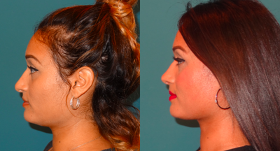 25-34 year old woman treated with Revision Rhinoplasty - Same patient with a profile view