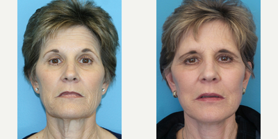 55-64 year old woman treated with Facial - This patient wanted to eliminate the deep wrinkles around her mouth. She had a full facelift, with fat grafting and a TCA Peel with Jessner's Solution.