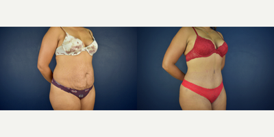 Caribbean Butt Lift, Tummy Tuck, Vaser Liposuction, Butt Augmentation, Hip Augmentation - This is 39 years old female patient was looking for body contour reshaping after her pregnancy. Dr. Valdez performed an extended tummy tuck, full body lipo with Vaser lipo and Microaire and fat transfer to her but and hips area the gave her the Caribbean hourglass body shape.