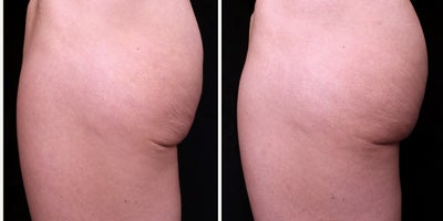 35-44 year old woman treated with Nonsurgical Butt Lift, Dermal Fillers - Check out these amazing results of a non-surgical butt lift!