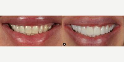 Woman treated with Smile Makeover, Porcelain Veneers, Dental Crown, Dental Implants - Our patient had been wanting a smile makeover to replace a missing tooth on her upper arch with a dental implant, improve the shade, and make her teeth less long and skinny.Shade: BL2/BL1 HT