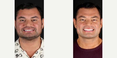 Man treated with Smile Makeover, Porcelain Veneers, Dental Crown - Treatment: upper 10 and lower 8 veneersShade: BL1HT