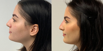 Woman treated with Nonsurgical Nose Job - Woman treated with Nonsurgical Nose Job