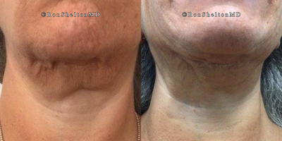 55-64 year old woman treated with Daxxify, Skin Tightening - After a neck lift and revision, the patient was still dissatisfied with her thick, hanging neck. With minimal fat, Kybella wasnt suitable. She opted to try Daxxify, and the results were far better than expectedshes now thrilled with the outcome.