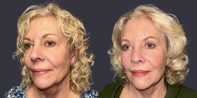 65-74 year old woman treated with ActiveFX, CO2 Laser, Eyelid Surgery, Laser Resurfacing - This 70 year had an upper and lower eyelid blepharoplasty surgery including CO2 laser resurfacing around the eyes. She is 5'6 tall and weighs 195 pounds. Her results are shown 6 months after surgery.