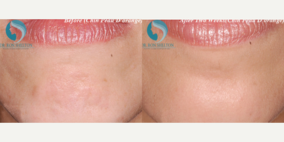 35-44 year old woman treated with Fraxel Repair - Botox softens the dimples of the chin (peau d'orange skin of the orange).