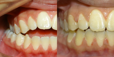 18-24 year old woman treated with Clear Braces - 18-24 year old girl treated with clear, ceramic braces.&nbsp;