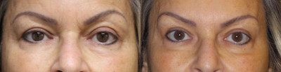 45-54 year old woman treated with Juvederm - Patient was treated with Juvederm to the glabella to improve 11 lines