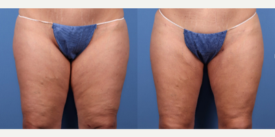 37 year old woman treated with Power-Assisted Liposuction (PAL), Liposuction - arm, thigh, and knee liposuction