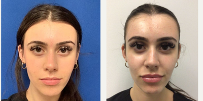 18-24 year old woman treated with RHA Collection Fillers - RHA 4 placed to Cheeks, RHA 3 placed to Lips