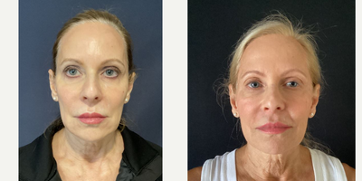 55-64 year old woman treated with Restylane Lyft - Restalyne lift placed to Jawline, Cheeks, and Nasolabial folds.