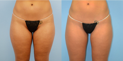 25-34 year old woman treated with Liposuction Revision - 25-34 year old woman treated with Liposuction Revision
