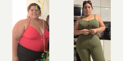 Woman treated with Gastric Sleeve Surgery - Educational moment with Dr K!
