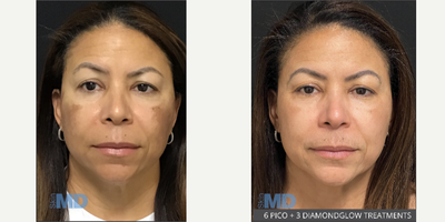 35-44 year old woman treated with Skin Rejuvenation, Skin Lightening - This beautiful patient came to Skin MD looking to address pigmentation, skin texture and skin rejuvenation.  6 PICO Genesis treatments combined with 3 DiamondGlow facials -- look at the amazing results thus far!