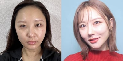 25-34 year old woman treated with Canthoplasty, Double Eyelid Surgery, Thread Lift, Facial Fat Transfer, Rhinoplasty - 25-34 year old woman treated with Canthoplasty, Double Eyelid Surgery, Thread Lift, Facial Fat Transfer, Rhinoplasty