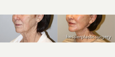 Woman treated with Lip Surgery - Woman treated with Lip Surgery through Lip Lift as well as Deep Plane Facelift, Neck Lift with submentoplasty and Laser Resurfacing. Patient was concerned that her face and neck were looking old and not representative of her active lifestyle. She didnt want procedures with repeated temporary treatments but, was seeking a long term rejuvenation.