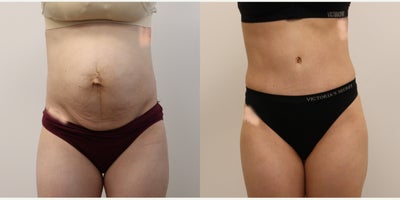 35-44 year old woman treated with Tummy Tuck, Diastasis Recti Repair, Umbilical Hernia Repair - This busy mom sought tummy tuck with diastasis repair after pregnancy with twins. She had her core muscles restored to the proper position and is thrilled! Shown here 6 months after surgery. (A small umbilical hernia was repaired as well)