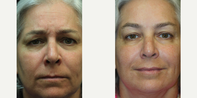 45-54 year old woman treated with Botox for Migraines - 50 year old woman seeking to address early signs of aging consulted with Dr. Kris Reddy FACS. Dr. Reddy performed Botox about 40 units and dermal fillers (1 syringe of Juvederm Ultra in the nasolabial folds and perioral lines and 1 syringe of Voluma for the lower face and chin area). Patient wanted to have Botox performed for cosmetic reasons and to treat migraine headaches.