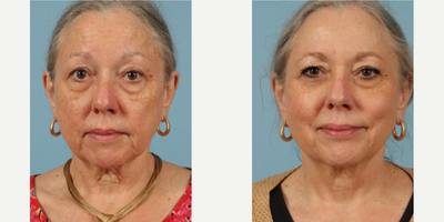 55-64 year old woman treated with Obagi Nu-Derm - 55-64 year old woman treated with Obagi Nu-Derm