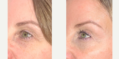35-44 year old woman treated with NeoGen Plasma - 90 Days following one Neogen Plasma session on Full Face.