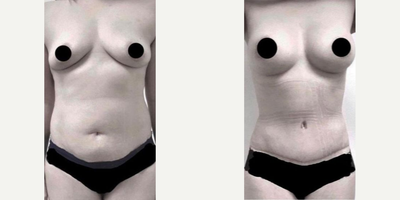 Woman treated with Mommy Makeover - Woman treated with Mommy Makeover