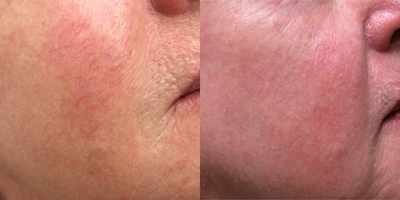55-64 year old woman treated with Vein Treatment - This patient was treated with veingogh for the removal of the tiny little veins on the face.