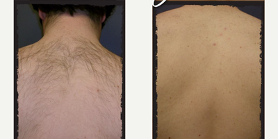 Man treated with Laser Hair Removal - Man treated with Laser Hair Removal.