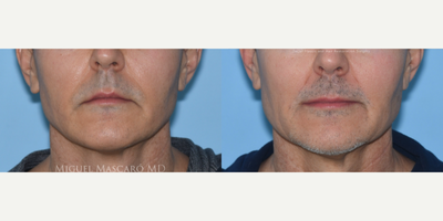 Man treated with Lip Lift - Man treated with corner Lip Lift. Pre-op, patient had a lip lift by another provider, and complains that the sides were drooping and he looked angry.