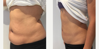 25-34 year old woman treated with CoolSculpting - Patient looking to address stubborn fat around abdomen and lower back.