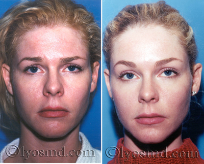 Endoscopic Browlift and CO2 Laser Resurfacing - Facelift - 	35-year-old woman before and after endoscopic browlift and skin resurfacing with CO2 laser