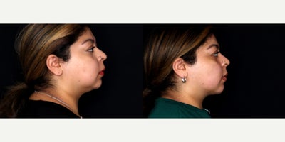 23 year old woman treated with Liposuction, PrecisionTx, Facial Fat Transfer to chin - 23 year old female treated with liposuction to face and submental neck (Precision tx) and fat transfer to the chin. Photos depict before and 3 months after surgery