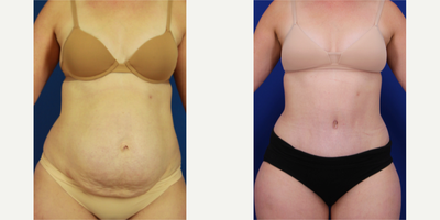 25-34 year old woman treated with Drainless Tummy Tuck, Diastasis Recti Repair - 3 months post drainless abdominoplasty and rectus diastasis repair.