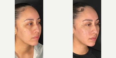 25-34 year old woman treated with Dermal Fillers - Lets talk facial harmony! 