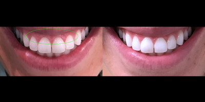 25-34 year old female treated with Botox for Gummy Smile - Neuromodulator injections to address gummy smile.