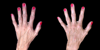 55-64 year old female treated with Hand Rejuvenation - Hand rejuvenation with dermal fillers