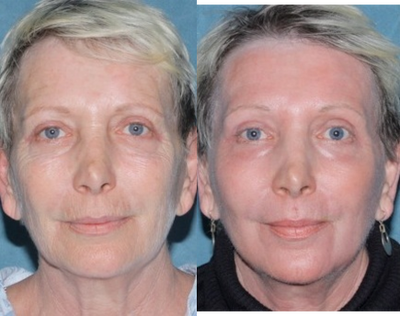 Laser resurfacing treatment for wrinkles - Patient before and after laser resurfacing for wrinkles.