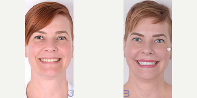 Woman treated with Porcelain Veneers - Woman treated with Porcelain Veneers