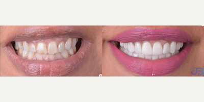 Woman treated with Porcelain Veneers, Gum Lift - Woman treated with Porcelain Veneers, Gum Lift