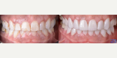 Woman treated with Porcelain Veneers, Gum Lift - Woman treated with Porcelain Veneers, Gum Lift
