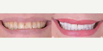 Woman treated with Porcelain Veneers - Woman treated with Porcelain Veneers