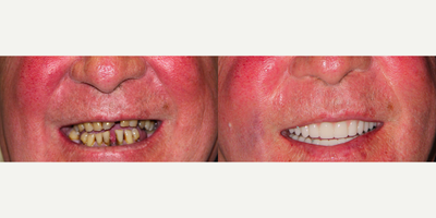 All-on-4 Dental Implants - All-on-4 Dental Implants