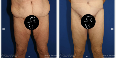 35-44 year old woman treated with Body Lift - This female patient in their 40s was not happy with the excess skin and fat in their thighs. So, Dr. Katzen performed a medial thigh lift.